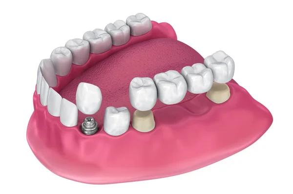 Zębów Obsługiwane Stałego Mostu Implantu Korony Medycznie Dokładne Ilustracja — Zdjęcie stockowe