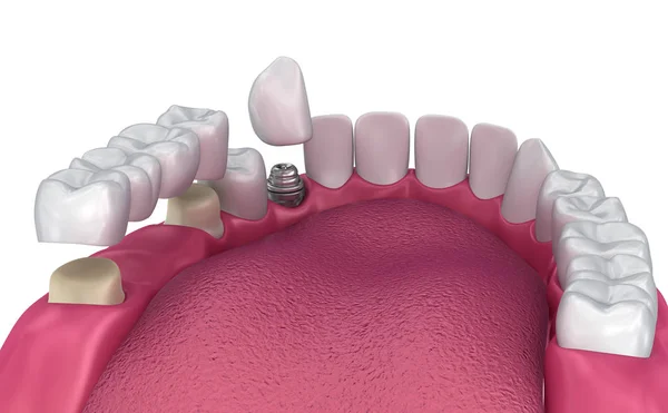 Tooth supported fixed bridge, implant and crown. Medically accurate 3D illustration