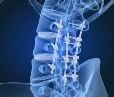 Spinal fiksasyon sistemi - titanyum braket. X-ışını görüntüsü. 3d illüstrasyon