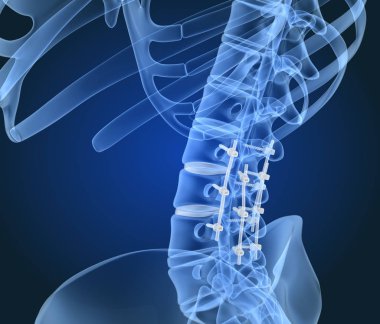 Spinal fiksasyon sistemi - titanyum braket. X-ışını görüntüsü. 3d illüstrasyon
