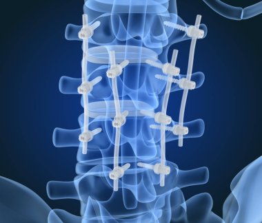 Spinal fiksasyon sistemi - titanyum braket. X-ışını görüntüsü. 3d illüstrasyon