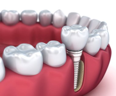 Diş implant ve taç yükleme işlemi. Tıbben doğru 3d çizim