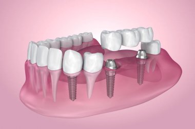 Desteklenen sabit köprü implant. Saydam görünümü. Tıbben doğru 3d çizim