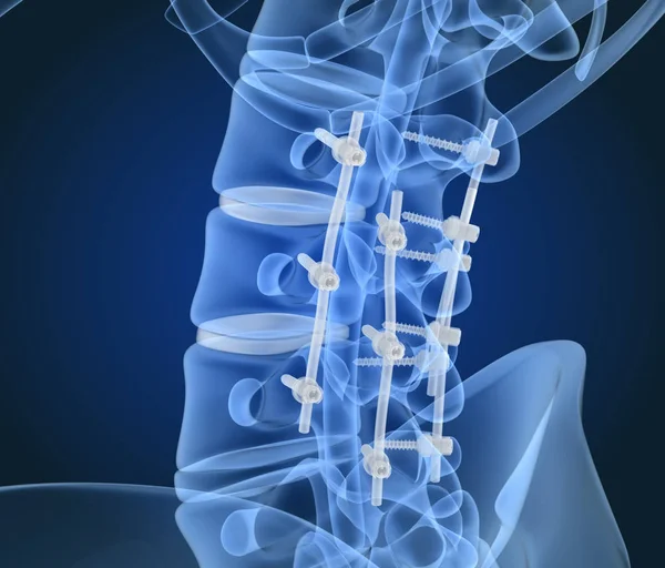 Spinal Fixation System Titanium Bracket Ray View Illustration — Stock Photo, Image