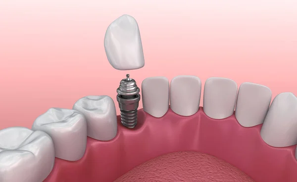 Implante Dental Proceso Instalación Corona Ilustración Médicamente Precisa — Foto de Stock