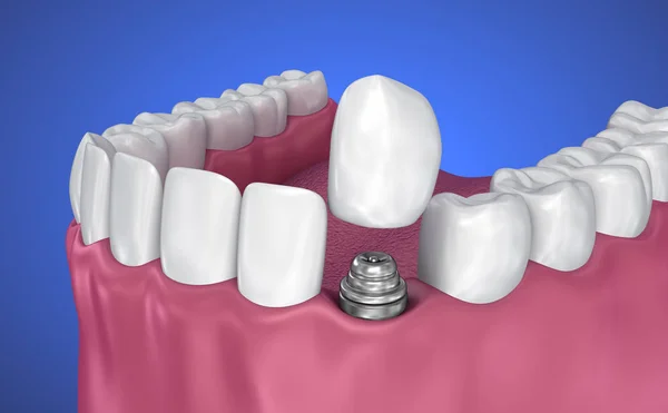 歯のインプラントとクラウンのインストール プロセス 医学的に正確な イラスト — ストック写真