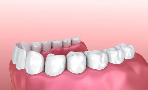 Pastilha Elástica Dentes Ilustração Dente Medicamente Precisa — Fotografia de Stock