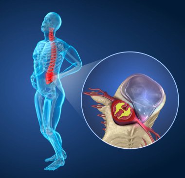 Bel fıtığı sonrası spinal ağrı atak, omurilik ağrısı çeken adam. 3d illüstrasyon