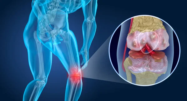 膝の痛み 膝に苦しむ男 3Dイラスト — ストック写真