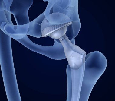 Kalça protezi implant leğen kemiği yüklü. X-ışını görünümü. Tıbben doğru 3d çizim