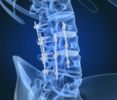 Spinal fiksasyon sistemi - titanyum braket. X-Ray 3d illüstrasyon