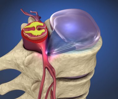 Omurilik şişkin disk, 3d çizim baskısı altında