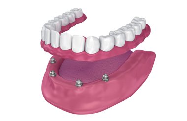 Overdenture implant - top ekleri oturmak için. 3D çizim