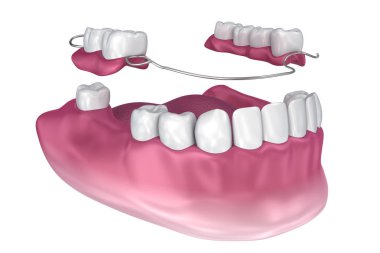 Çıkarılabilir kısmi takma diş. Tıbben doğru 3d çizim