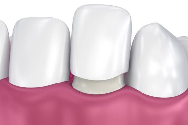 Diş kaplama: Porselen kaplama yükleme yordamı. 3D çizim