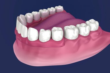 Overdenture 4 implantlar üzerinde oturacak - top ekleri. 3d illüstrasyon