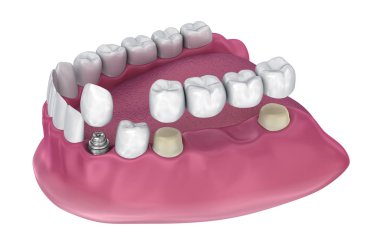 Desteklenen sabit Köprülü, implant ve taç diş. Tıbben doğru 3d çizim