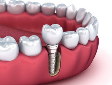 Diş implantı instalasyon süreci , Tıbbi olarak doğru 3d illüstrasyon