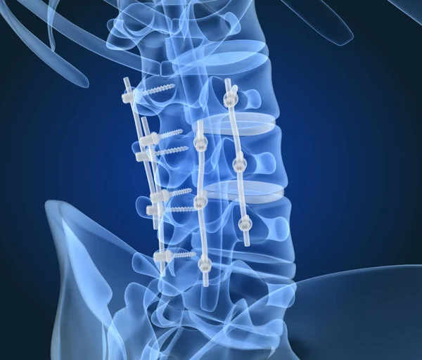 Spinal fiksasyon sistemi - titanyum braket. X-Ray 3d illüstrasyon