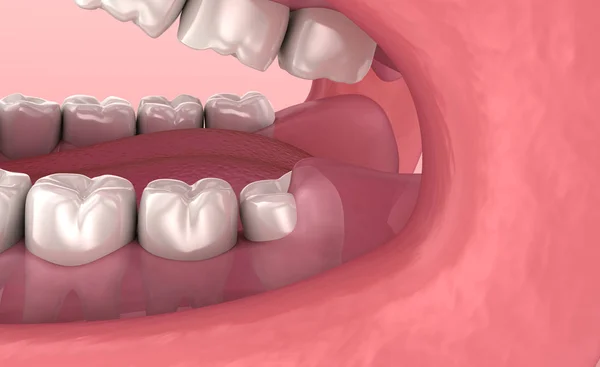 Problema Dientes Sabiduría Animación Dientes Médicamente Precisa — Foto de Stock