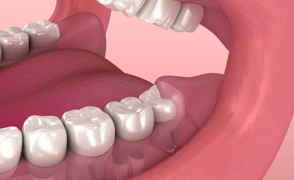 Wisdom tooth problem. Medically accurate tooth 3D animation