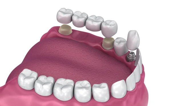 Zębów Obsługiwane Stałego Mostu Implantu Korony Medycznie Dokładne Ilustracja — Zdjęcie stockowe