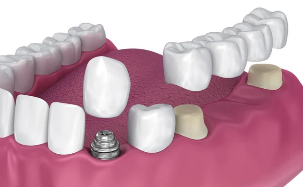 Dente Supportato Ponte Fisso Impianto Corona Illustrazione Clinicamente Accurata — Foto Stock