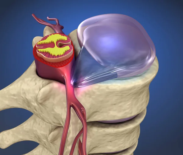 Ruggenmerg Onder Druk Van Uitpuilende Schijf Illustratie — Stockfoto