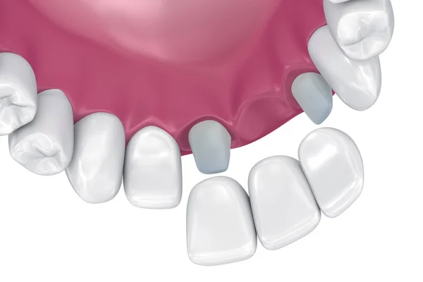 Ponte Fisso Supportato Dai Denti Illustrazione Clinicamente Accurata — Foto Stock