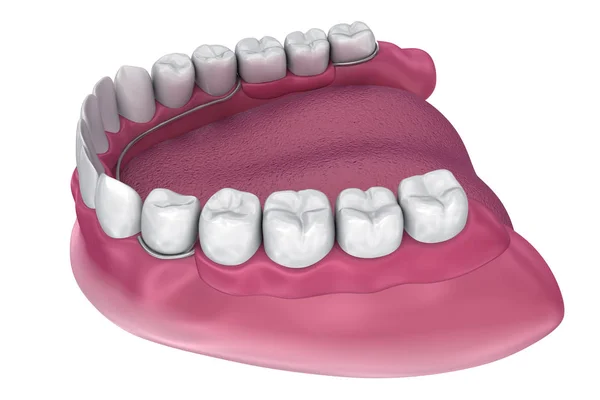 部分床義歯 医学的に正確な イラスト — ストック写真