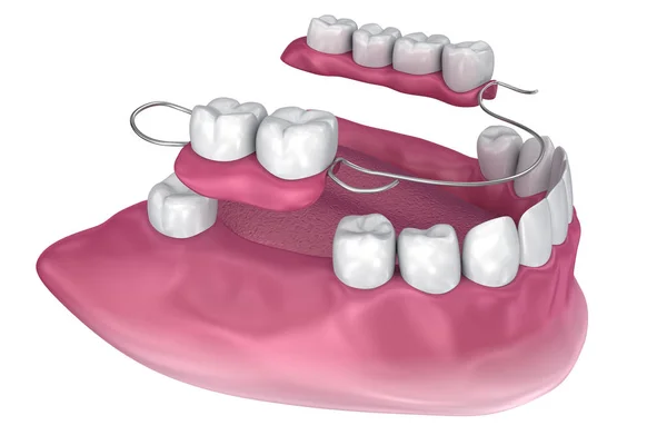 可拆卸部分义齿 医学上精确的3D — 图库照片