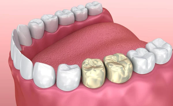健康な歯と 医学的に正確な歯の イラストレーションの黄金の冠 — ストック写真