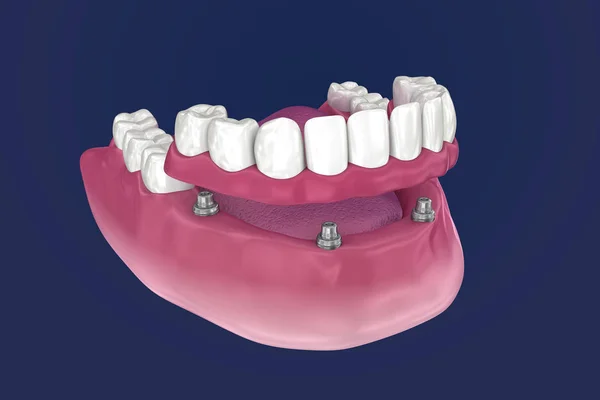 Overdenture Att Sitta Implantat Ball Bilagor Illustration — Stockfoto