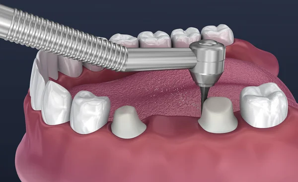 牙齿支撑3个牙齿的固定桥 医学上精确的 — 图库照片