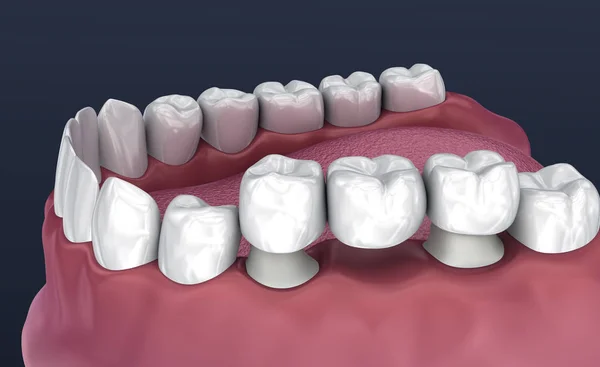 Tooth Ondersteunde Vaste Brug Van Tanden Medisch Nauwkeurige Illustratie — Stockfoto