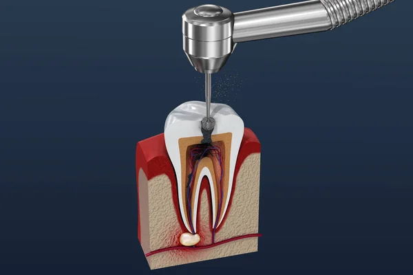 Root canal treatment process. 3D illustration