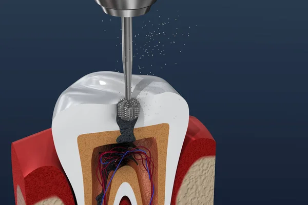 Processo Tratamento Canal Radicular Ilustração — Fotografia de Stock