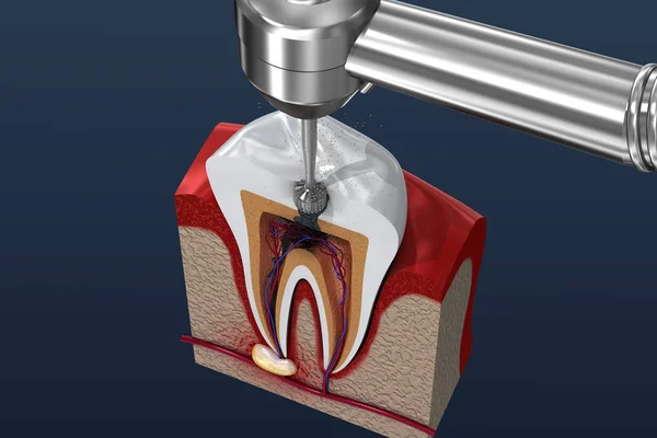 Root canal treatment process. 3D illustration