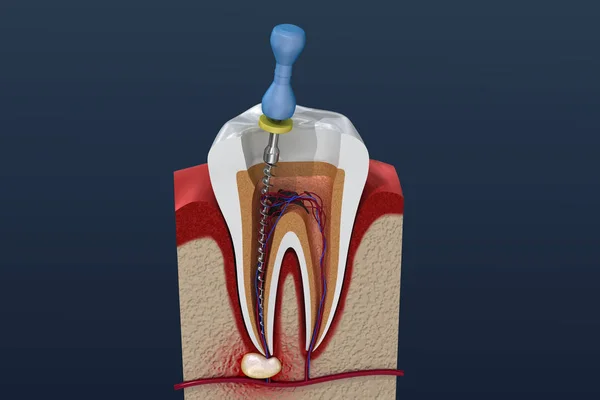 Proceso Tratamiento Del Canal Radicular Ilustración — Foto de Stock