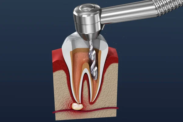 Root Canal Treatment Process Illustration — Stock Photo, Image