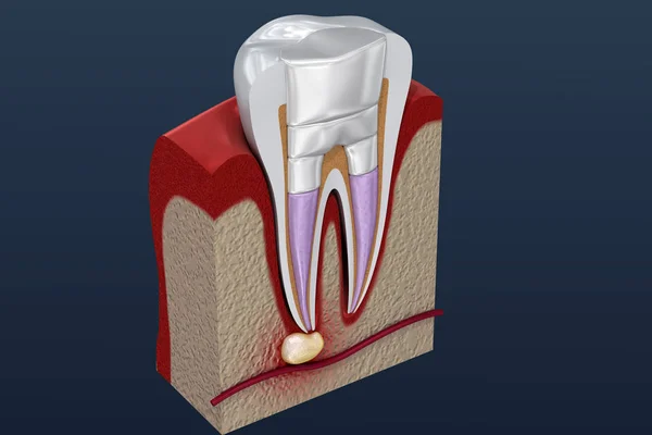 Схема Процедури Заповнення Зубів Ілюстрація — стокове фото