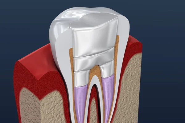 Schema Della Procedura Otturazione Dentale Illustrazione — Foto Stock