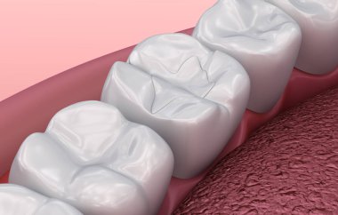 Diş çatlak dolgular, Tıbbi olarak doğru 3d illüstrasyon