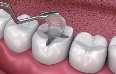 Diş çatlak dolgular, Tıbbi olarak doğru 3d illüstrasyon
