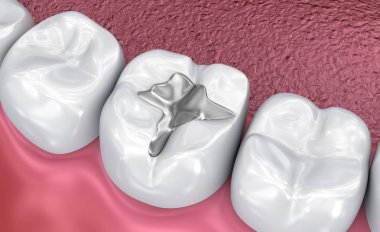 Diş çatlak dolgular, Tıbbi olarak doğru 3d illüstrasyon