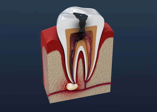 Decadência Dentária Ilustração — Fotografia de Stock