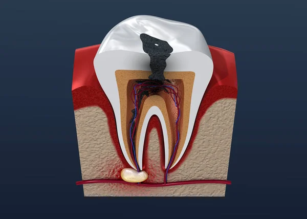 Caries Dental Ilustración — Foto de Stock
