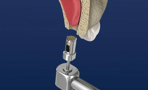 シナスリフト手術 シナスオーグメント 3Dイラスト — ストック写真