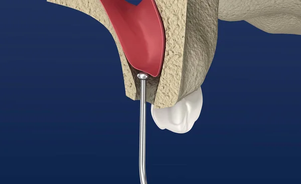Sinus Lift Chirurgie Sinus Augmentation Illustration — Stockfoto