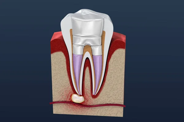 Dental Fillings Procedure Diagramm Illustration — Stock Photo, Image